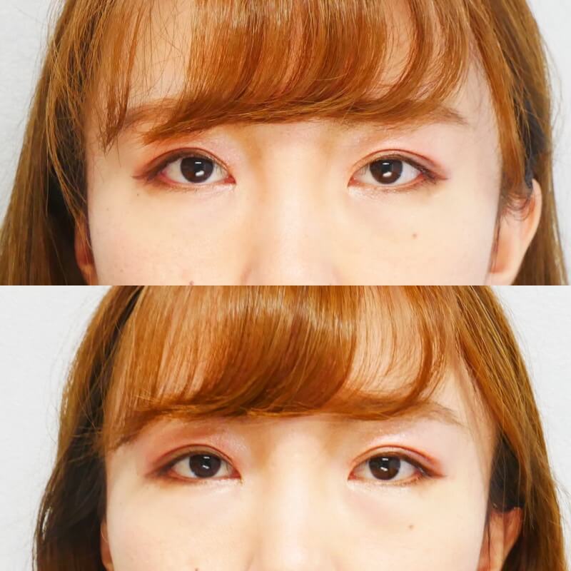 アーモンドアイボトックス 症例 たれ目 名古屋